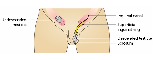 Undescended testes